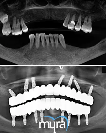 types-of-dental-implants