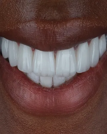 7-benefits-of-dental-veneers,