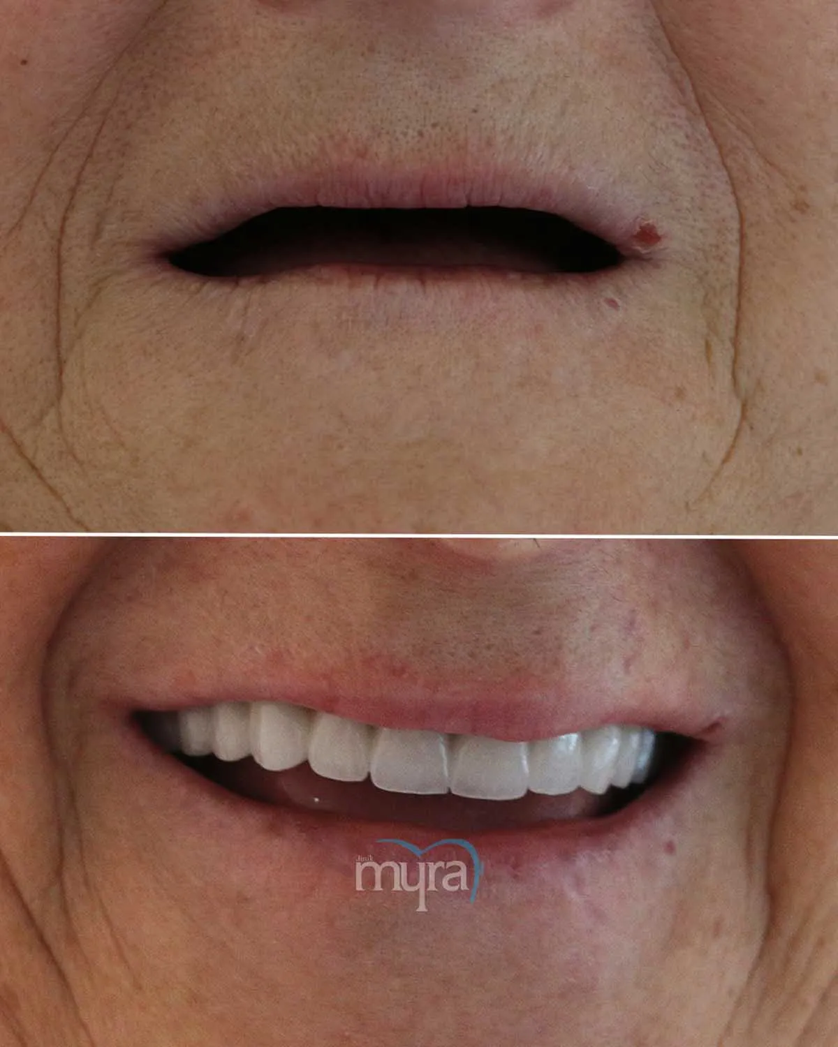Comparison-of-denture-quality-and-price-in-Turkey-and-the-USA,