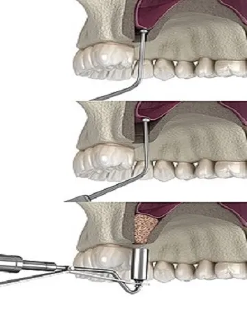 Sinus-Lift-Definition