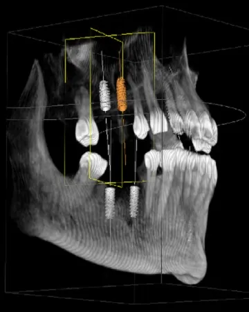 advanced-dental-implant-procedures-and-technology