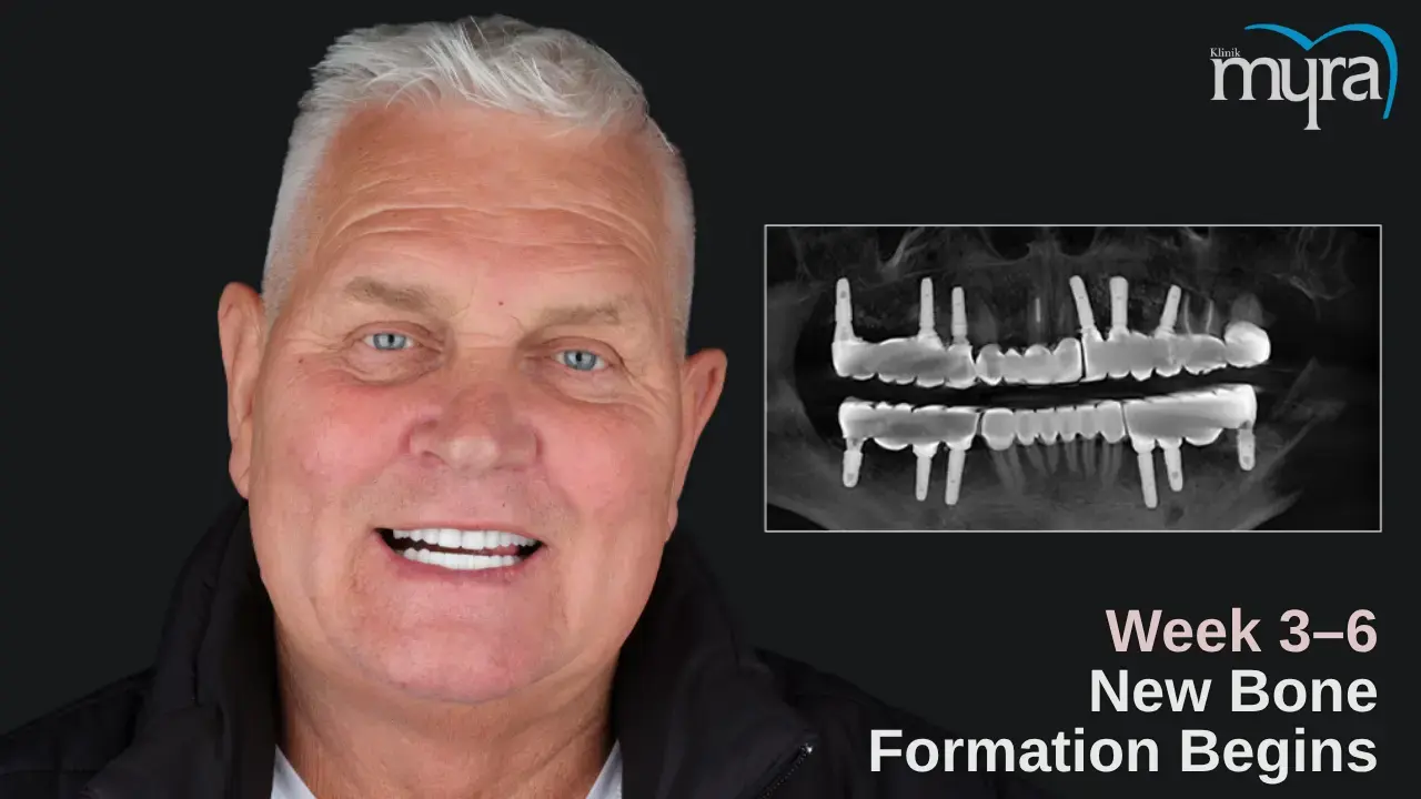 3-early-bone-regeneration-3-6-weeks
