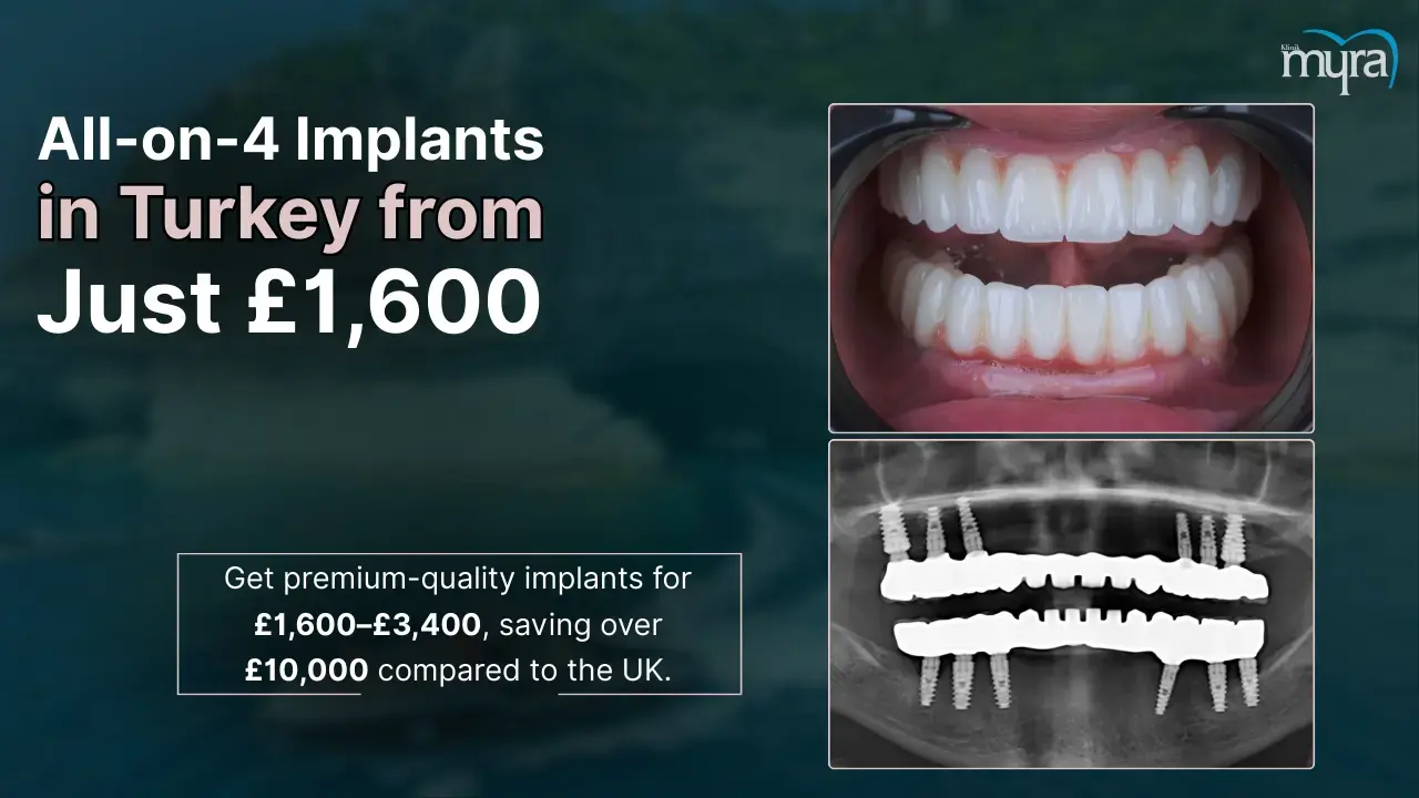how-much-are-all-on-4-dental-implants-in-turkey