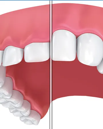 gum-contouring-definition-benefit-cost-and-recovery-duration,