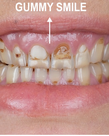Gummy Smile: Definition, Types, Benefits, and Cost,