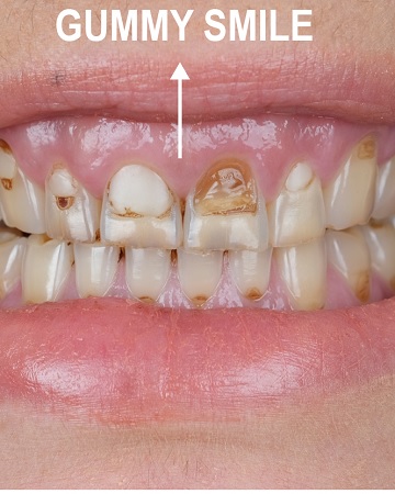 Gummy Smile: Definition, Types, Benefits, and Cost