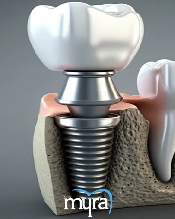 dental-implant-recovery-duration-tips-and-things-to-avoid