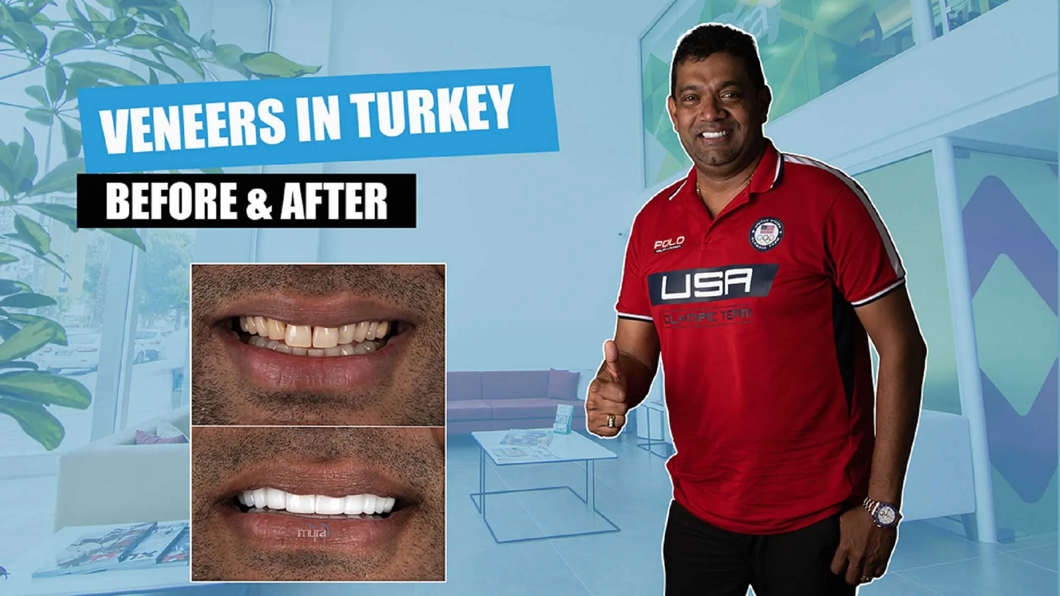 full-set-of-veneers-in-turkey,