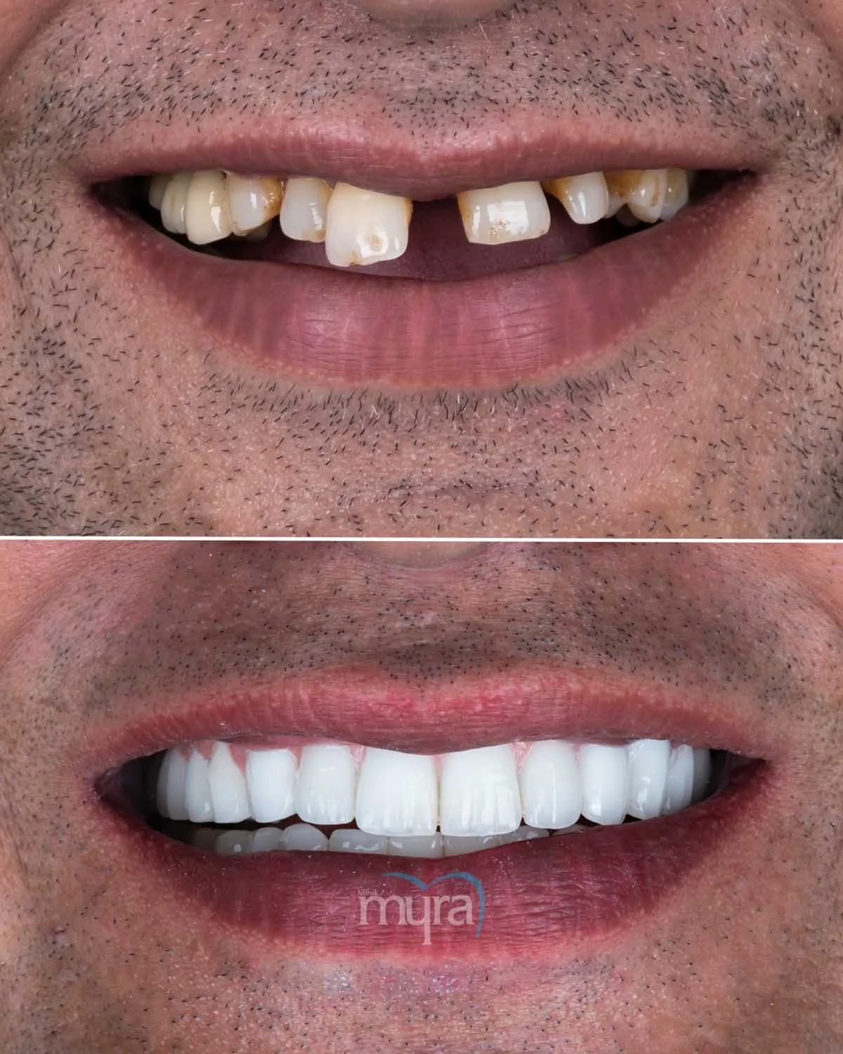 Typical number of veneers required for dental restoration,
