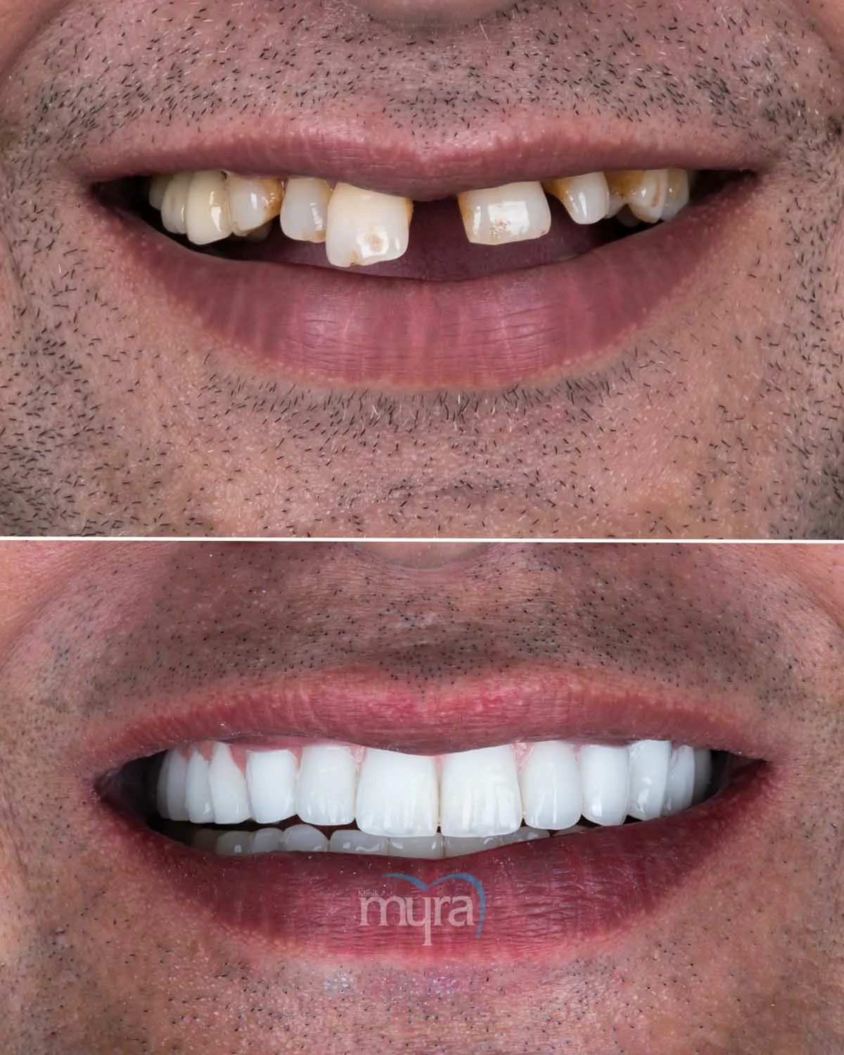 Typical number of veneers required for dental restoration