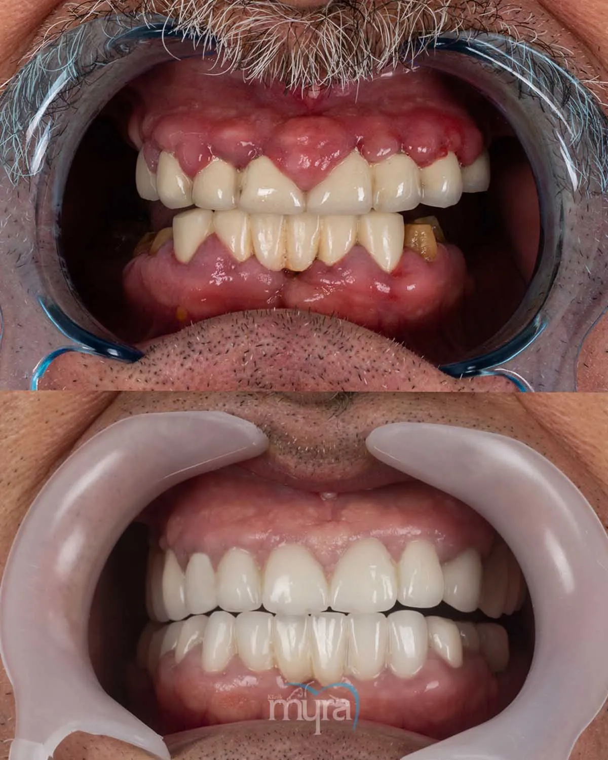 how-much-are-dental-implants-in-turkey