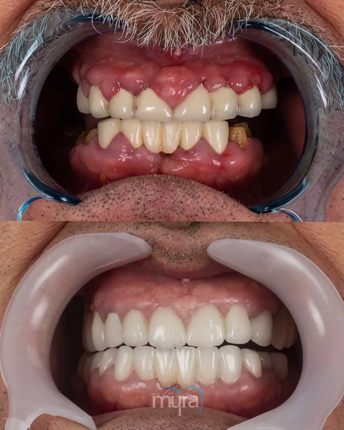 Dental implants Kent