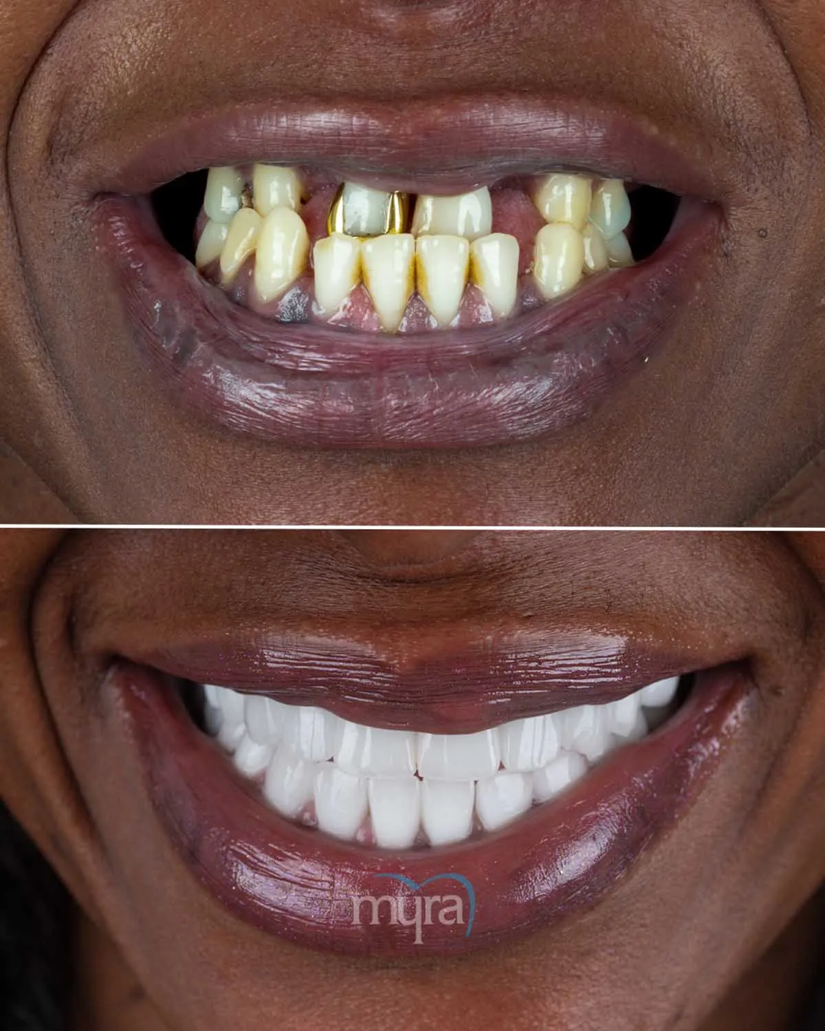 Ideal Interval for Implant Maintenance,