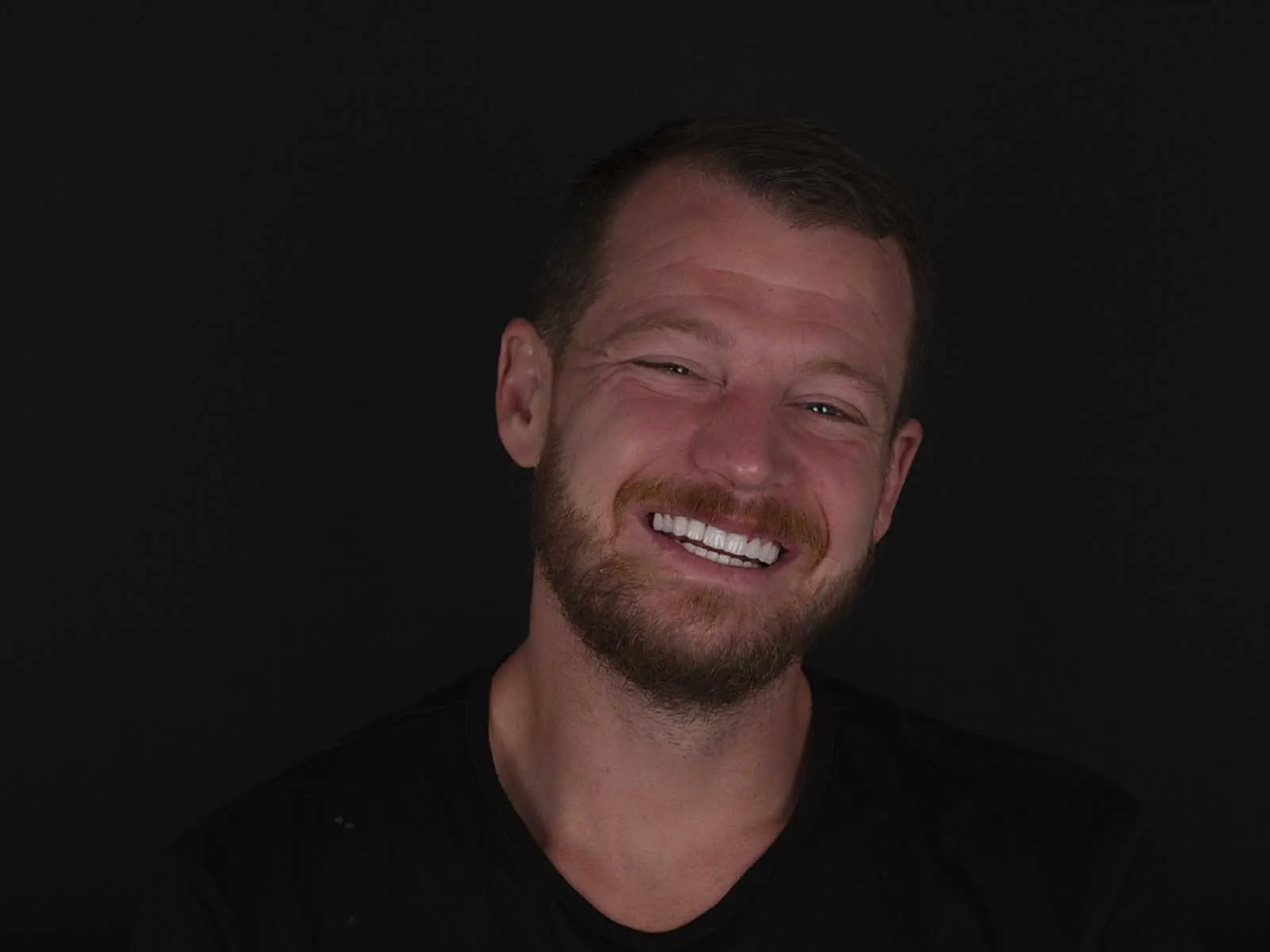 Benefits of obtaining a full set of veneers in Turkey,