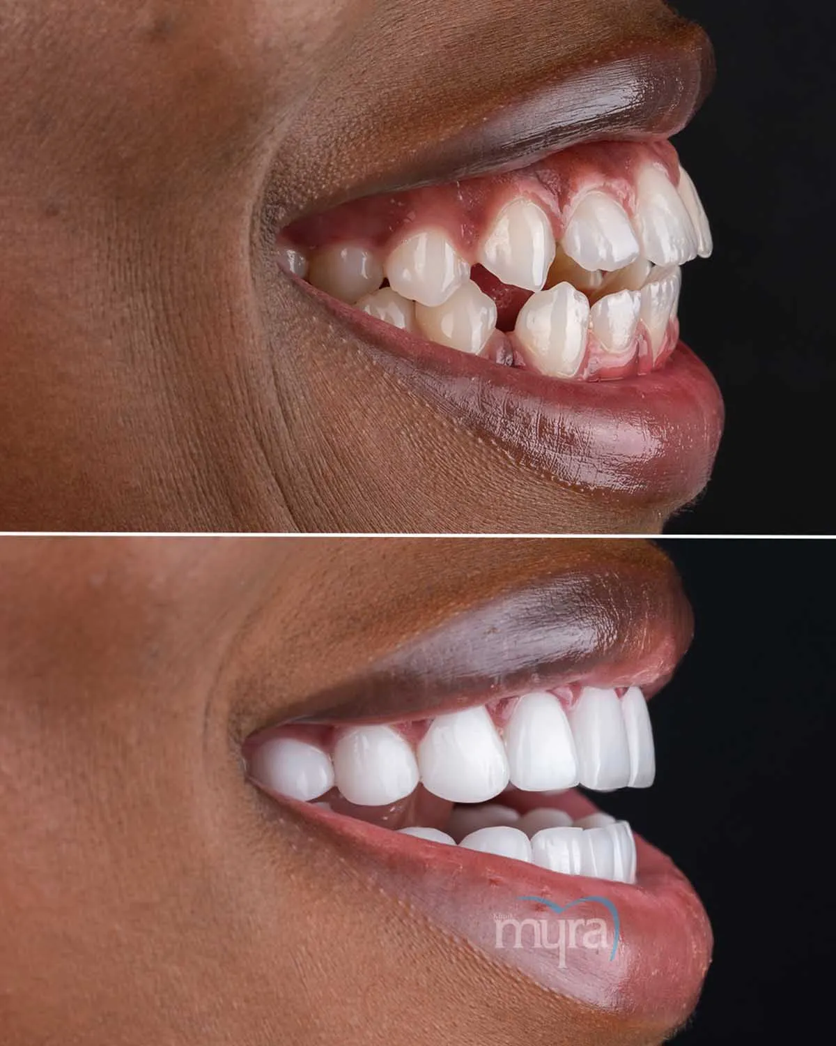 porcelain veneers