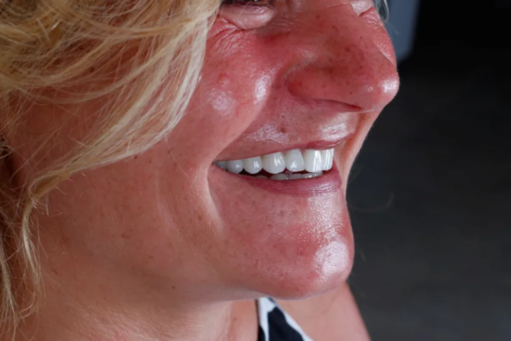 Myra Dental Centre Turkey - 15-important-decisions-for-new-teeth-in-turkey