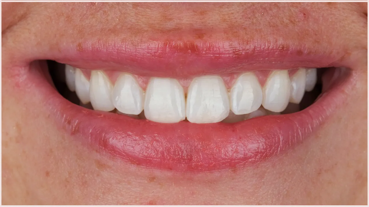 Myra Dental Centre - risks-and-considerations-of-teeth-whitening-what-you-should-know