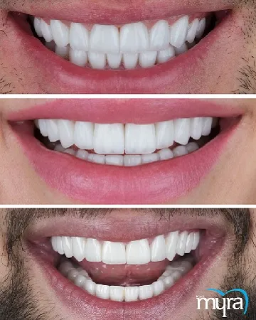 porcelain veneers