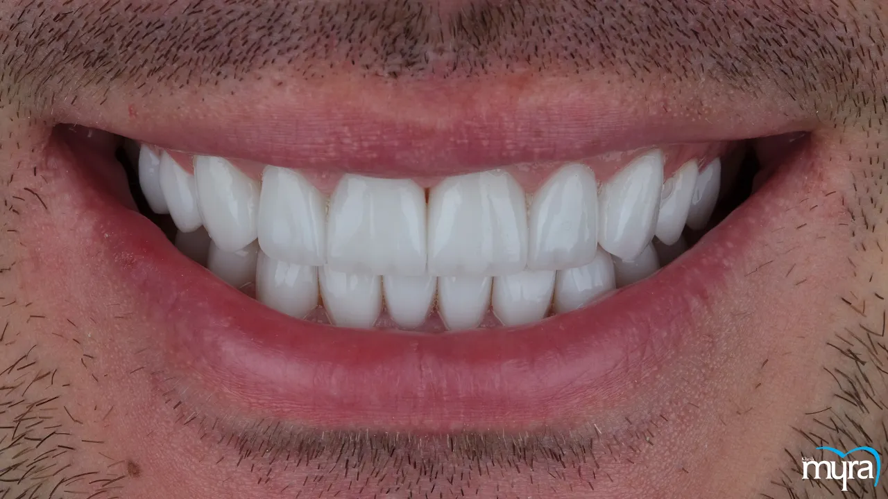 Benefits of Dental Veneers