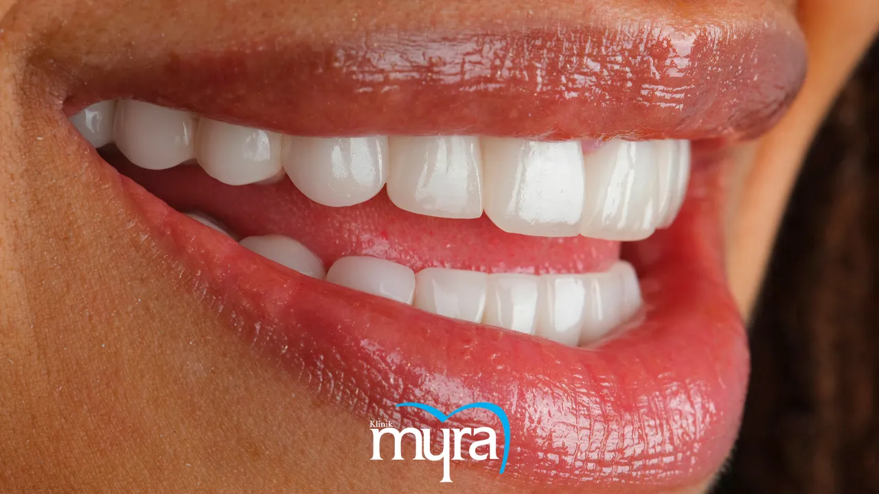 Myra Dental Centre - 7 Benefits of Teeth Whitening
