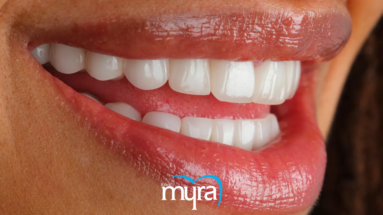 Benefits of Teeth Whitening