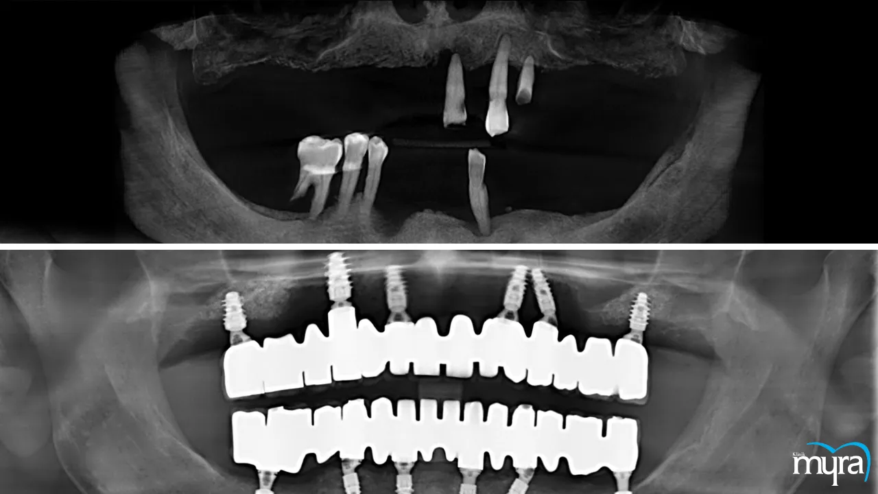 Popularity and value of dental treatments in Turkey