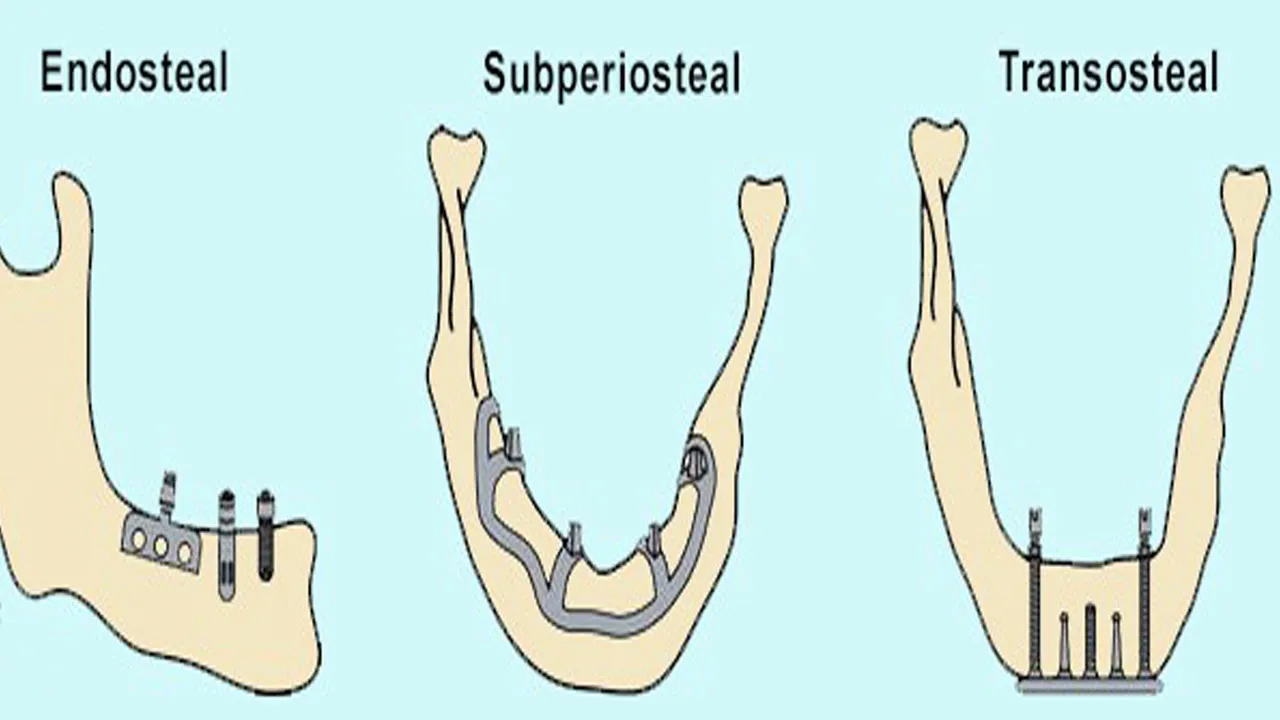 Types of Dental Implants