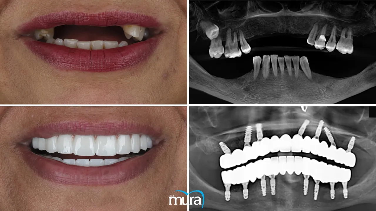 Types of Dental Implants