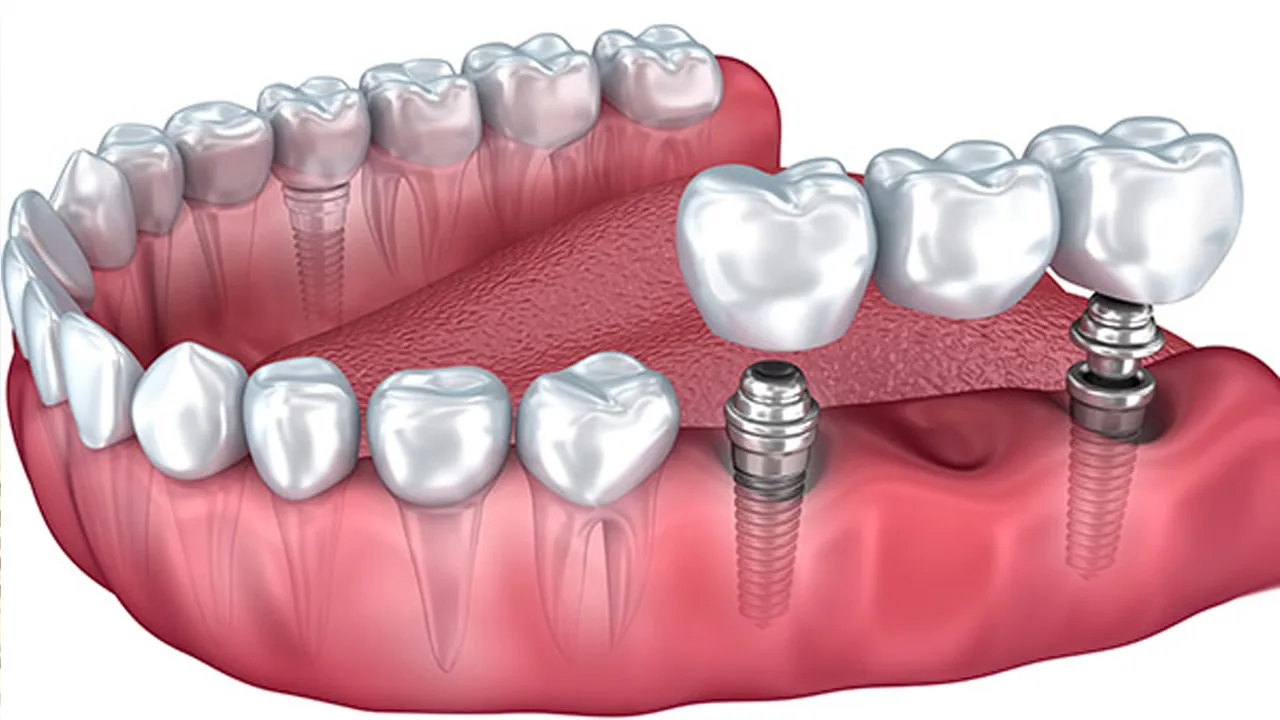 Types of Dental Implants