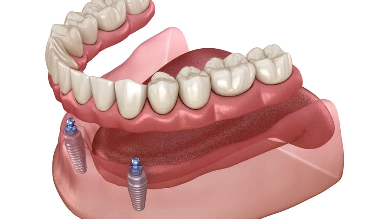 Types of Dental Implants