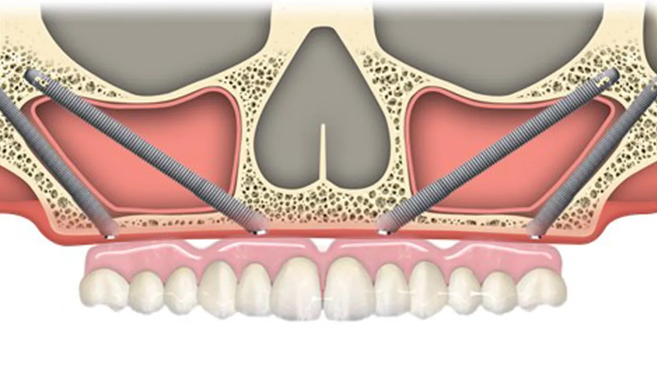 Types of Dental Implants