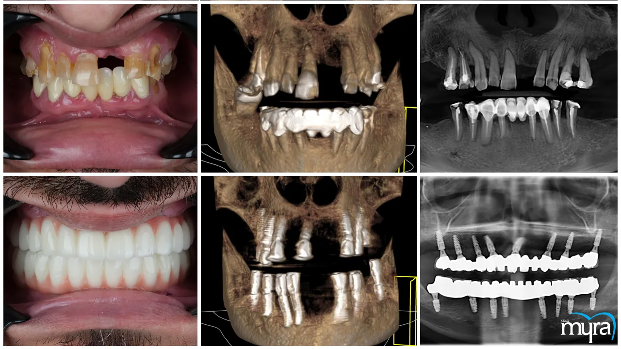 A Complete Understanding Of All-on-4 Dental Implant 
