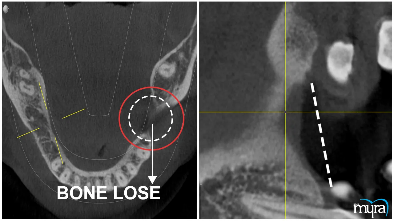 Advance Dental Implant Procedures