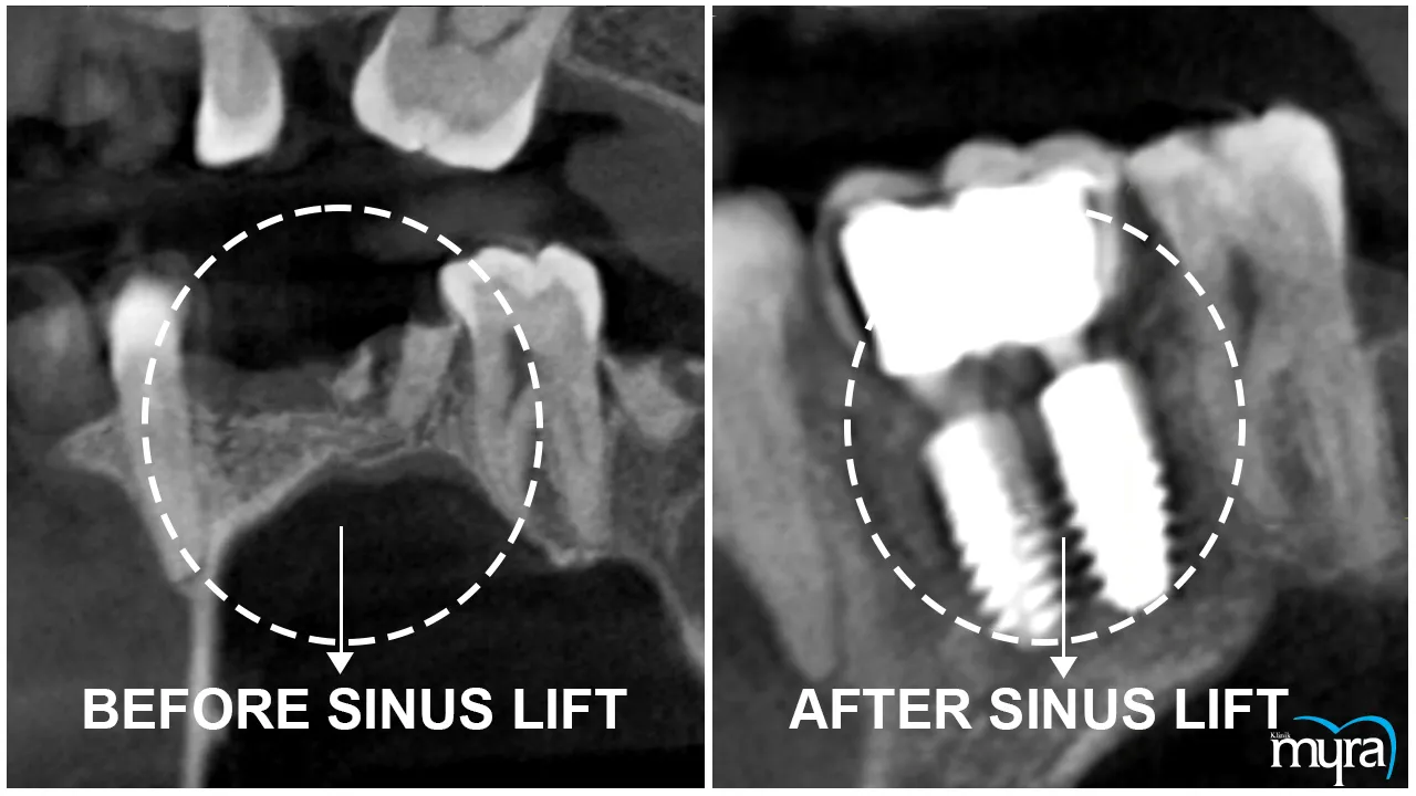 Advance Dental Implant Procedures