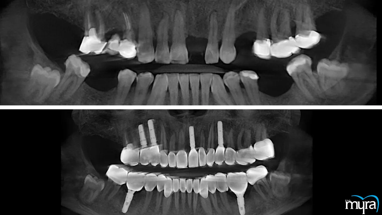 Finding the most affordable tooth implant options