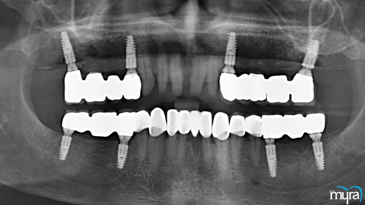 Myra Dental Centre Turkey-Dental-implants