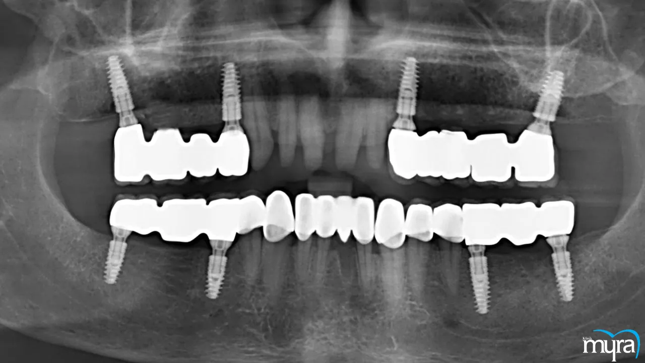 Dental implants