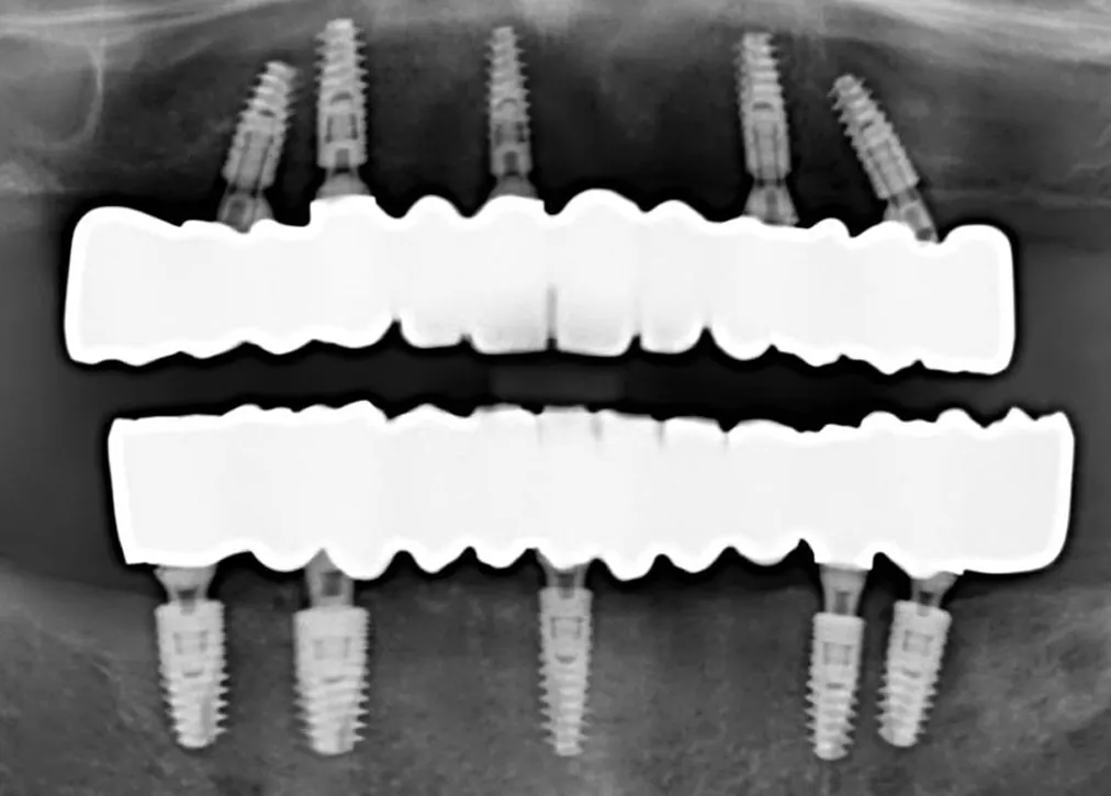 All-on-4 Dental Implants in Turkey: Cost, Pros, and Cons at Myra Dental Centre