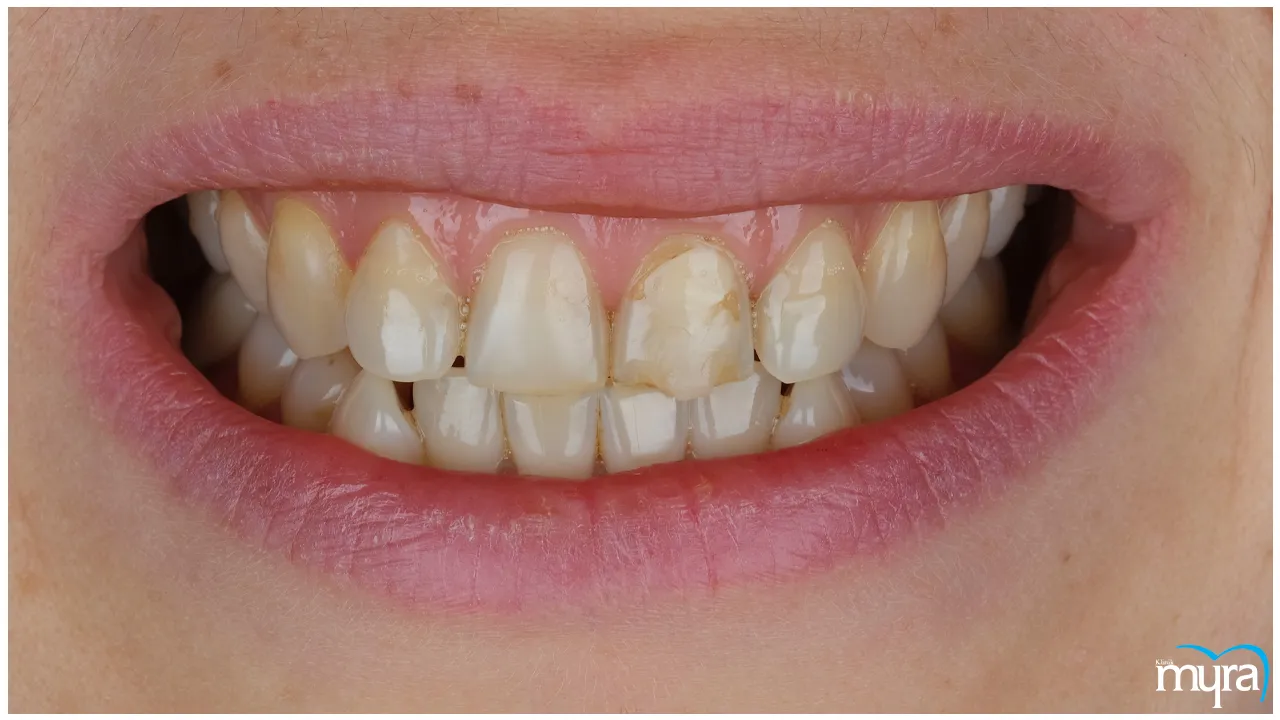 Gummy Smile Definition, Types, Benefits, and Cost- Myra Dental Centre Turkey