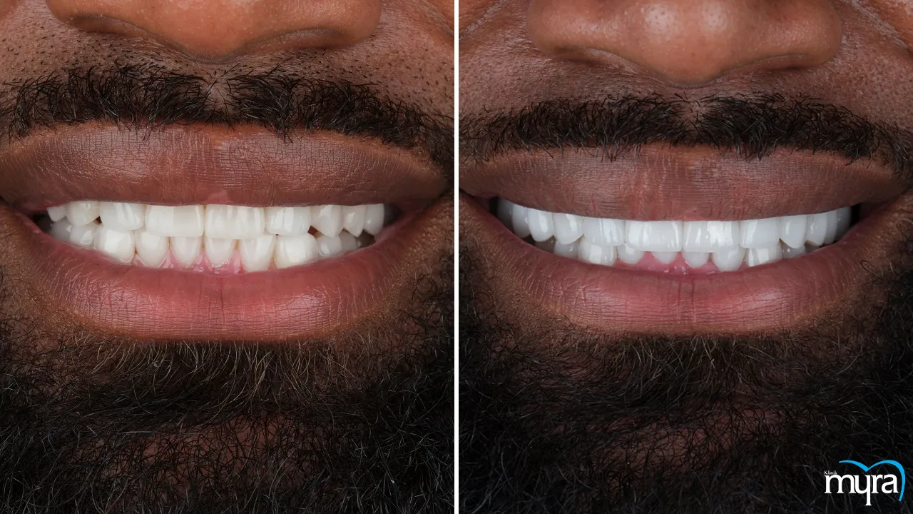 Dental Veneers Risks