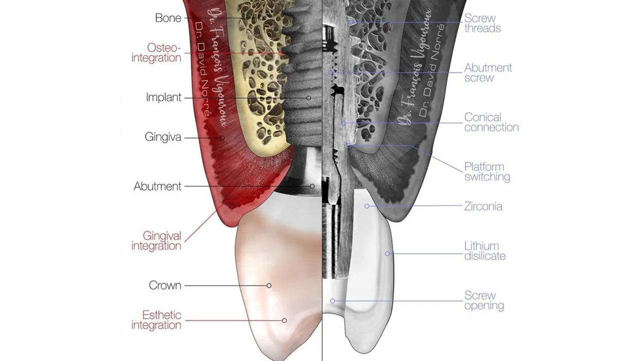 What is the maximum number of implants you can have?