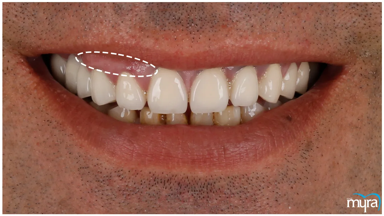 Gummy Smile Definition, Types, Benefits, and Cost- Myra Dental Centre Turkey