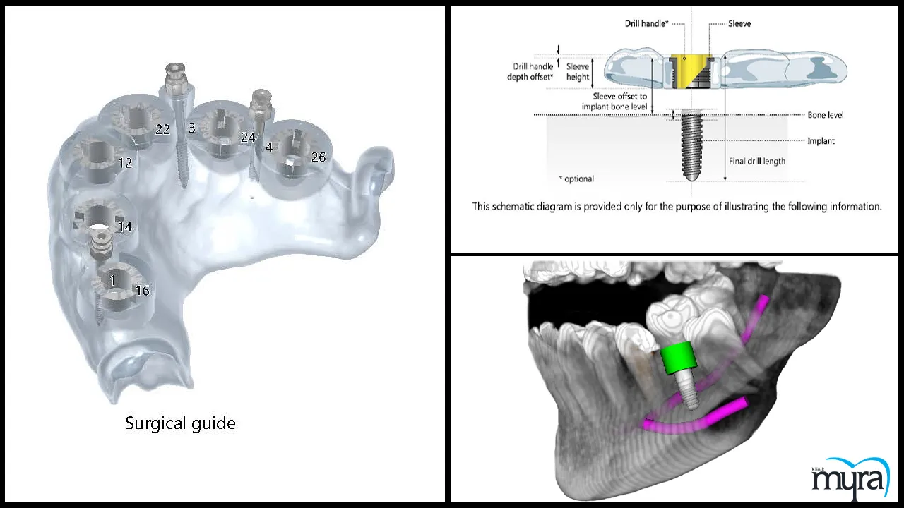Myra Dental Centre Turkey - advanced-dental-implant-procedures-and-technology