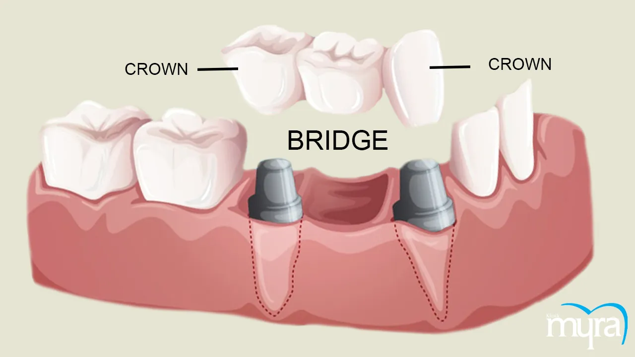 Smile Design Definition