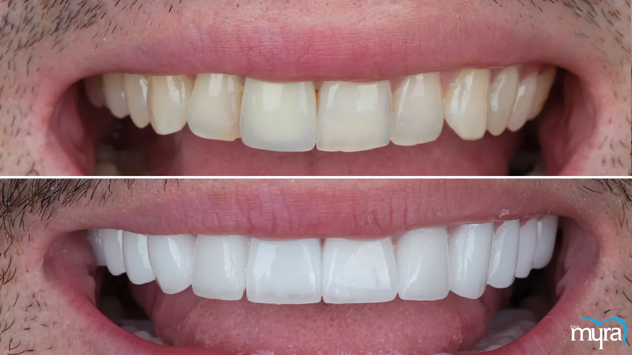 Myra Dental Centre Turkey - Dental Crown Definition Importance Types Procedure and Advantages