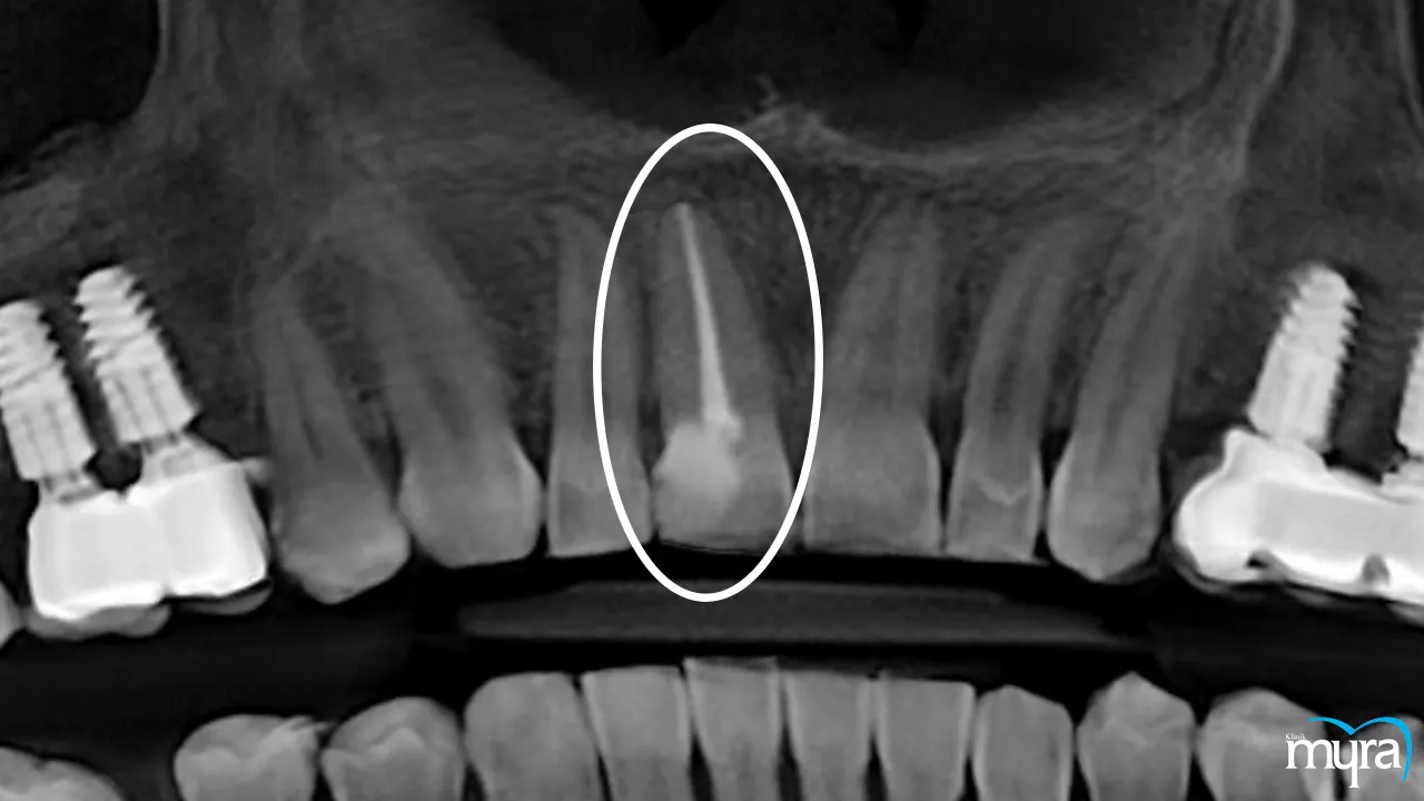 Dental Root Canal