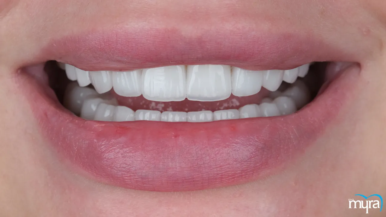 Benefits of Dental Veneers