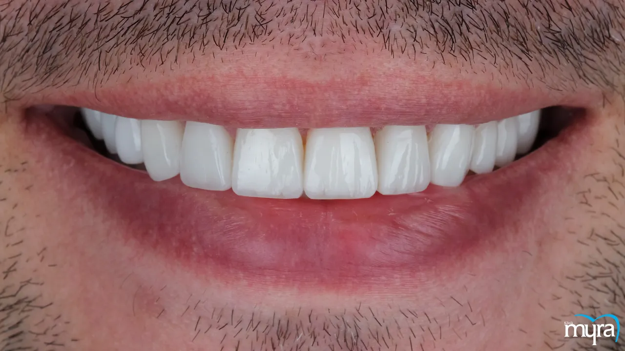 Myra Dental Centre - 7-benefits-of-dental-veneers