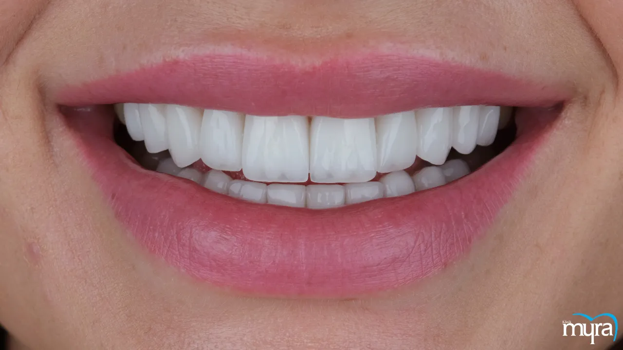 Myra Dental Centre - 7-benefits-of-dental-veneers