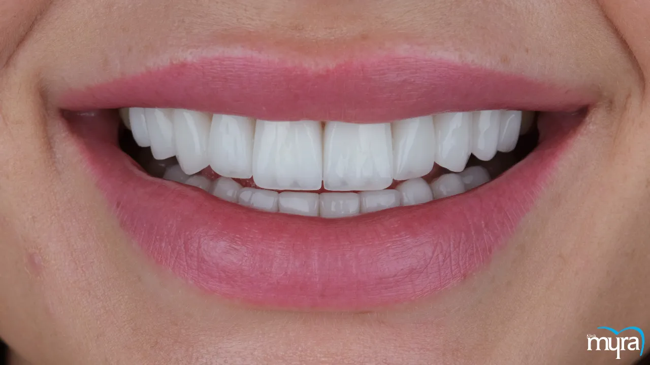 Benefits of Dental Veneers